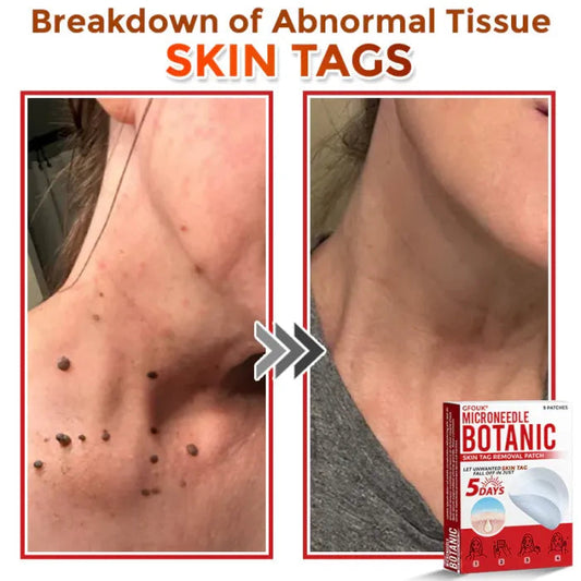 Smooth Skin Tag Remover